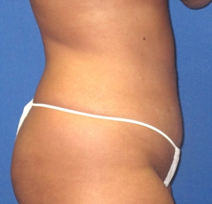 Liposuction #1-after