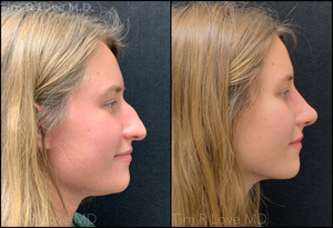 Patient is 5 week post op Rhinoplasty-before