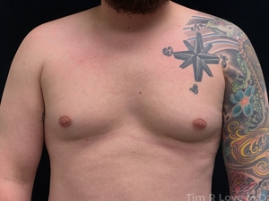 5'9 195lb 1 month post op BodyTite chest-before