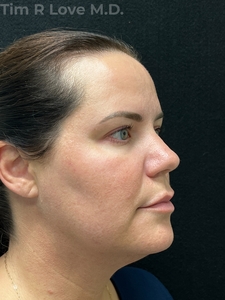 2 months post op Facetite, Morpheus8, and Sculptra-after