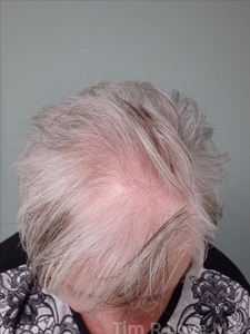 2500 Hair Grafts-before