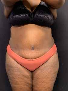 Tummy Tuck w/ plication + liposuction-low back + waist-before