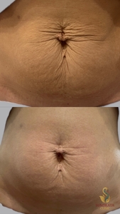 One XERF Treatment-before