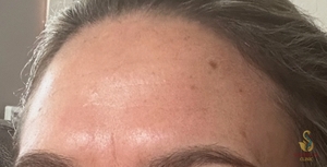 Nouvaderm Laser Treatment-Forehead-24 hours Post Treatment-before