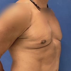 Male Breast Reduction #4 (right oblique)-after