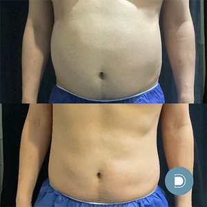 coolsculpting+cooltone-12-treatments-before