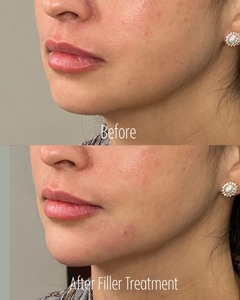 Filler B/A SBA 20-before