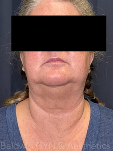 24 HOURS POST PROCEDURE-before