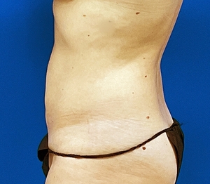 Liposuction #2-after