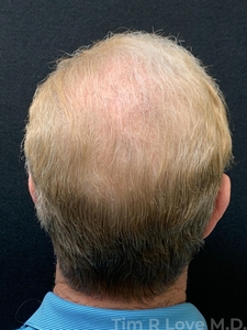 3000 grafts-after