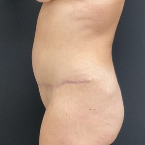 Tummy Tuck #11-after
