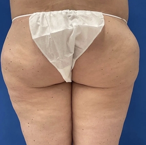 Lipo w Renuvion #1-before