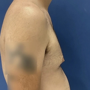 Male Breast Reduction #5 (right)-before