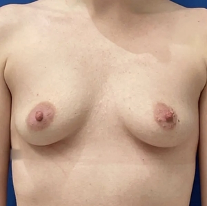Breast Augmentation #11 375 cc-before