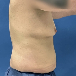 Tummy Tuck #9-before