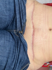 after 1 treatment of PDL-before