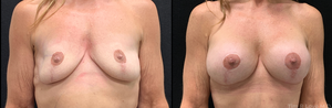 5'2, 120lb, 50 year old had mastopexy with 345cc shaped highly cohesive implants-before