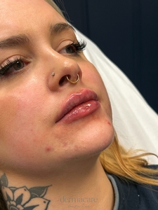 Whitney Devall RN. - Versa-after