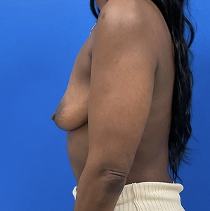 Breast Augmentation #6 350 cc-before