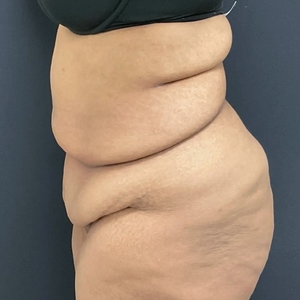 Tummy Tuck #16-before