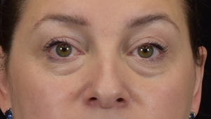 Undereye/Midface filler-before