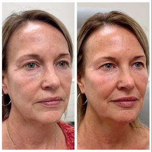 Botox-before
