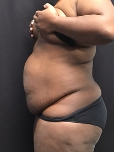 Lipo 360 + mini tummy tuck-before