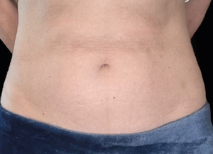 Emsculpt NEO #1-after