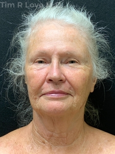1 year post op short scar face lift and upper lip lift, MyEllevate, Facetite, Morpheus8 x2, Sculptra x4 vials, 1 syringe of Restylane Kysse in lips-before