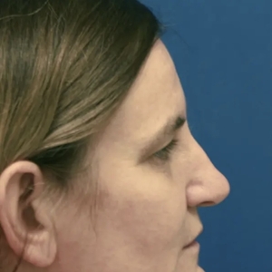 Brow & Eye Lift #1-before