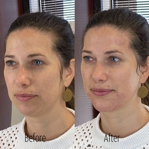 Filler B/A SBA 36-before