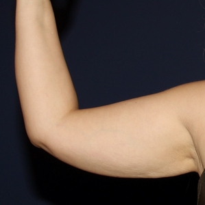 Lipo w BodyTite #7-after