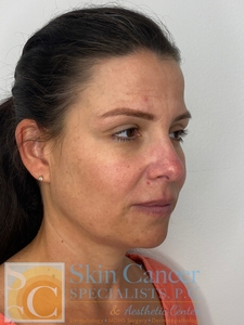 Voluma, Defyne and Botox-before