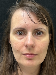 1 month post op Morpheus8 and Nanofat treatment-before