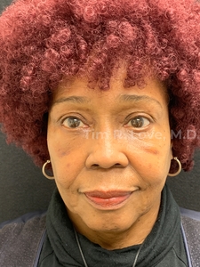 68 years old, orbital fat grafting-after