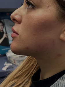 Jawline filler-before