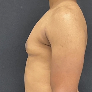 Male Breast Reduction #8-after