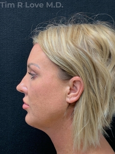 1 week post op chin implant-after