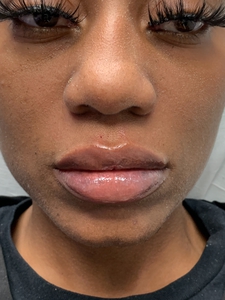 Lip Filler RHA 1cc-after