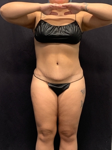 LAL-upper + lower abdomen-after