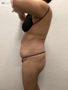 6 Sessions! Insta & Cryo Abd-before