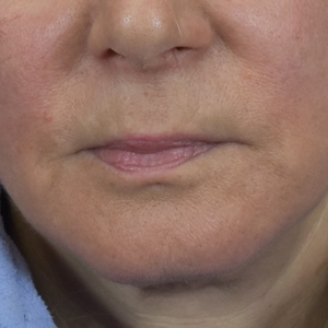 Marionette Lines-after