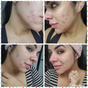 Dr. Ayala acne journey-before