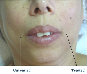 Nasolabial Folds-before