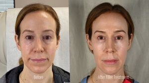 Filler RB B/A Frontal-before