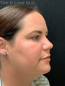 2 months post op Facetite, Morpheus8, and Sculptra-before