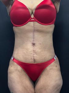 Tummy Tuck w/ Fluer de lis scar-after