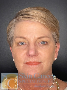 Filler around mouth and lips-before