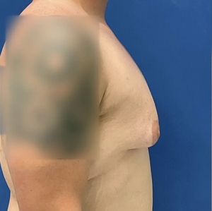 Male Breast Reduction #7-before