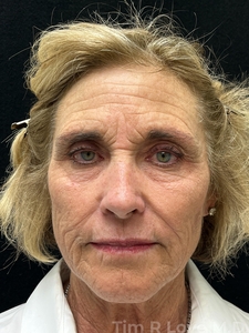 1 year post op short scar facelift, Morpheus 8, Fraxel, Sculptra, Lip filler-before
